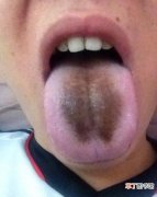 舌头上发黑是什么原因引起的_舌苔发黑可不是好事