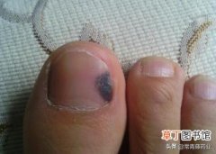 黑指甲是什么症状图片，指甲变黑了是身体出了问题吗