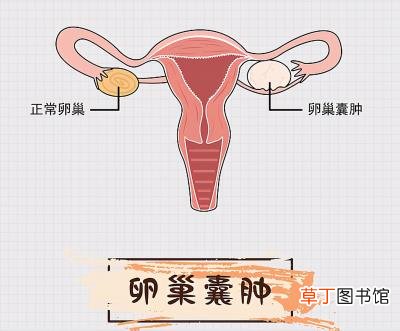囊肿是什么原因造成的，引起卵巢囊肿的四大原因