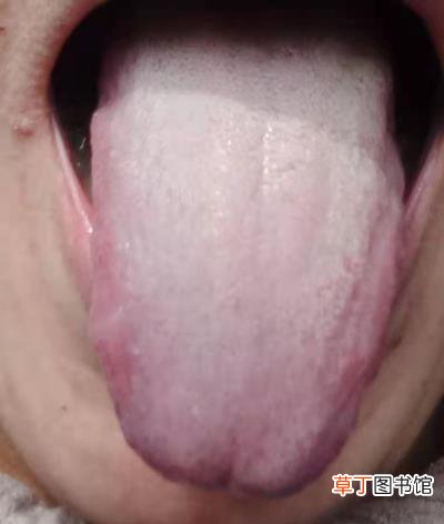 舌头有齿痕怎么调理，舌头出现齿痕