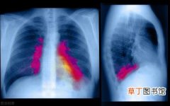 细菌性肺炎会传染吗，肺部感染需要警惕肺炎的出现