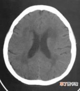 脑白质疏松是什么病，3种常见脑白质病CT表现