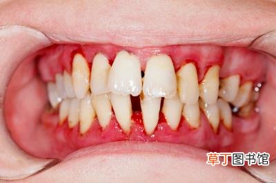 牙齿松动可以修复吗，牙龈萎缩牙齿松动有办法补救吗