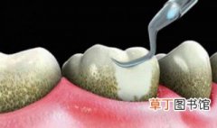 牙结石怎么自己去除 牙结石的危害