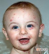 儿童湿疹的症状及治疗 儿童湿疹怎么治疗最好的方法