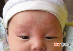热性湿疹的治疗方法 宝宝湿疹怎么治疗好得最快最有效