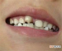 小孩换牙齿吃什么好换牙的四大注意事项