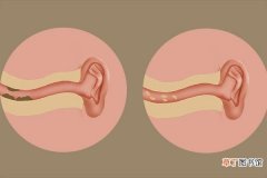 耳屎多是什么原因呢 耳屎是怎么产生的呢
