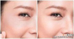 改善眼角纹的处理方法 如何去掉眼角皱纹