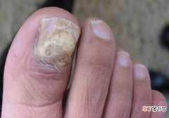 治疗灰指甲的方法 治疗灰指甲的几个小窍门