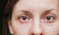 麦粒肿反复发作的4种原因 眼睛反复长麦粒肿的原因