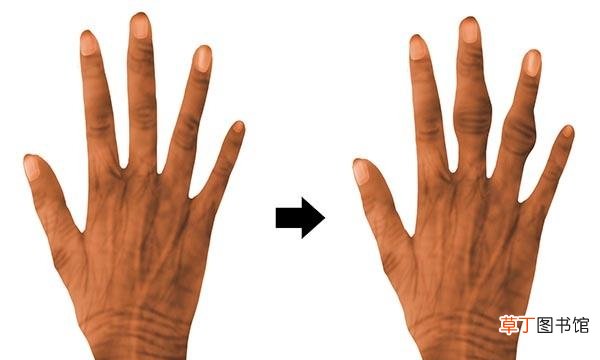 癌症给的手指2种警告 指甲中间凸起来了是什么原因