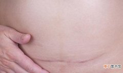 剖腹产后的疤痕增生该怎么办 破腹产疤痕增生怎么消除