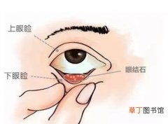 眼睛里长结石的原因分析 眼睛长结石是什么原因引起的