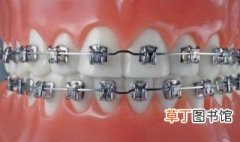 带牙套第几个月最丑 了解牙套矫正的阶段过程