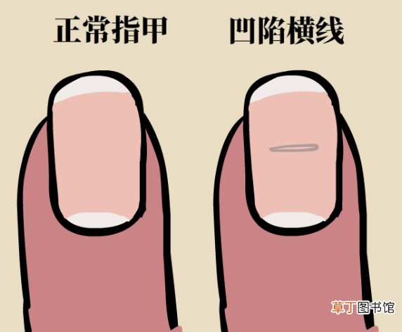 指甲出现凹痕的3个原因 指甲根部凹陷是什么原因