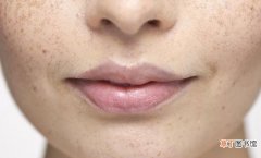 各种斑纹的区别介绍 脸上长黄褐斑是什么原因引起的