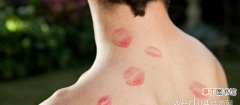 吻痕快速消除的5个妙招 怎么消除草莓印吻痕最快