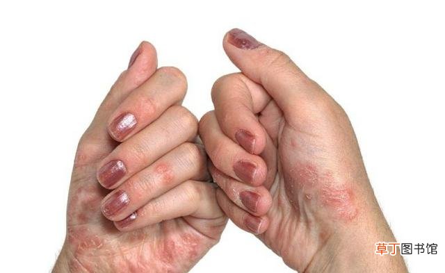 皮肤瘙痒不要慌，下面几个治疗方法请收好，教你正确护理皮肤！