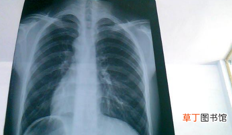 如何自查是否出现白肺 白肺是怎么引起的