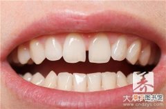 牙齿有缝怎么矫正啊？