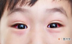 眼睑肿胀是红眼病的症状 预防红眼病多吃解毒食物