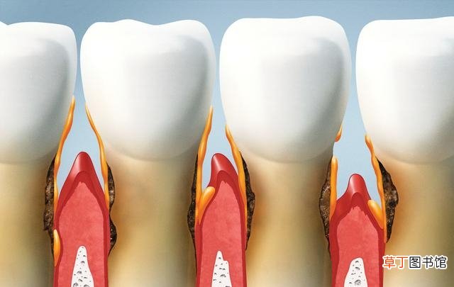 牙疼含白酒可以止疼吗 3个方法缓解疼痛