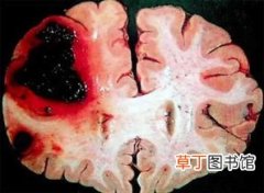 脑梗和脑溢血的区别,脑溢血和脑梗塞有什么区别？