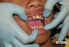 缩小牙缝自然办法是什么 怎么矫正门牙牙缝大