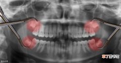 智齿后面的肉肿了怎么办 智齿发炎该怎么治疗