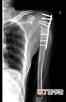 老人2次摔伤，多亏反置式人工全肩关节置换手术，让病痛“止步”