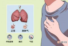 肺大泡为啥活不过5年 肺气肿肺大泡能活多久