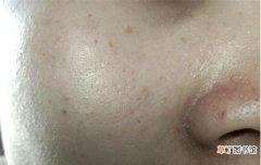 鼻子两侧毛孔粗大原因及怎么改善