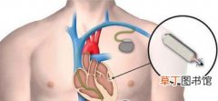 心梗装心脏起搏器,心肌梗塞后，需安心脏起搏器吗