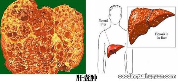 肝脏有囊肿的原因 肝脏有囊肿是怎么回事