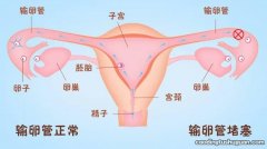 碘油造影对输卵管助孕作用 油剂造影剂持续妊娠率更高