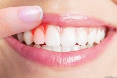 产后牙龈红肿出血什么原因 跟坐月子的习俗有关